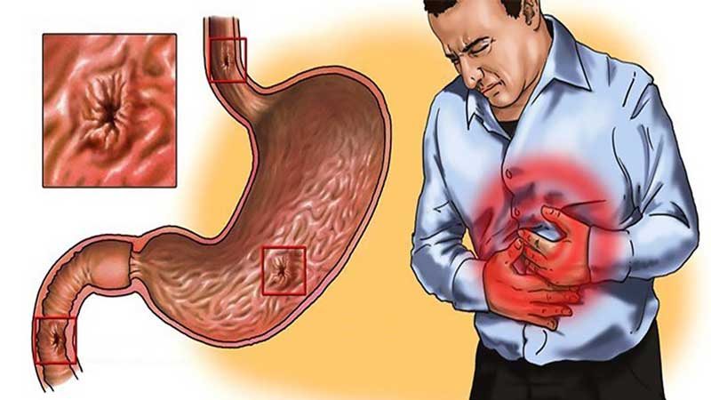 Er det muligt at spise rødbeder med gastritis: bliv bekendt med kontraindikationer og forbered dig efter de bedste opskrifter på en svag mave