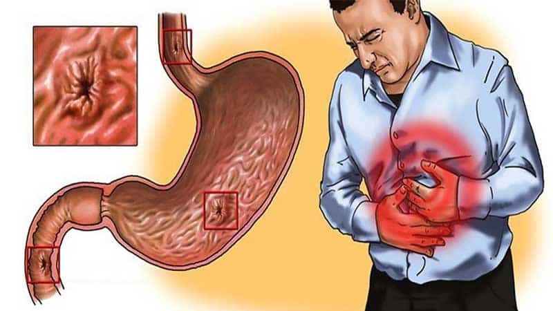 È possibile mangiare l'aneto per la gastrite e come utilizzarlo nelle ricette della medicina tradizionale