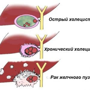 Je možné jíst meloun s cholecystitidou a pankreatitidou?