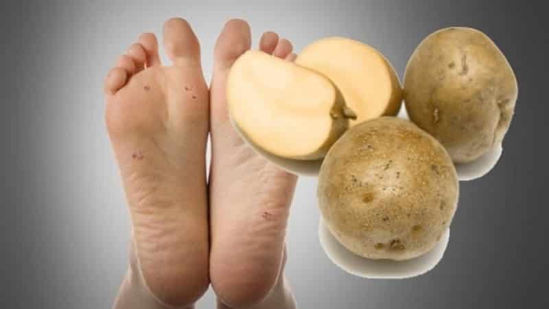 How to get rid of warts using potatoes