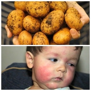 Comment l’allergie à la pomme de terre se manifeste-t-elle chez les enfants et les adultes ?