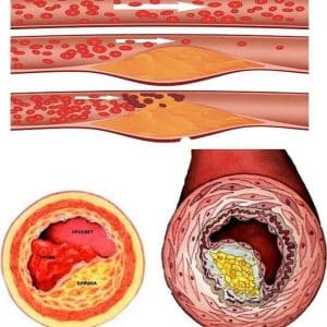 Cách chữa 100 bệnh: Công dụng vỏ hành tây trong bài thuốc dân gian