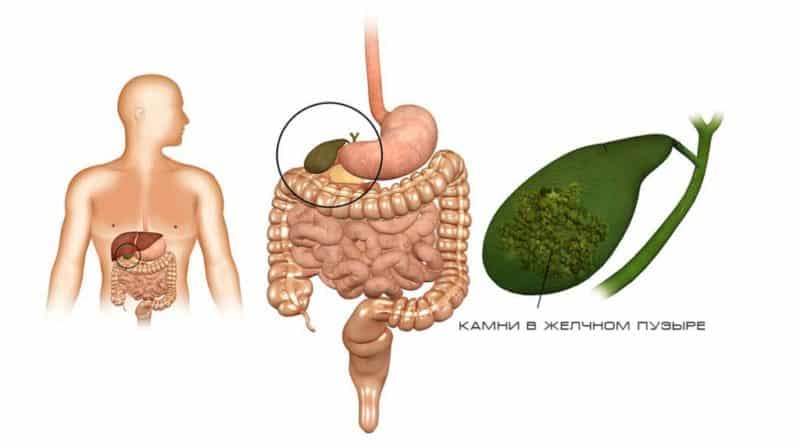 Melancia para cálculos biliares: pode-se comer e em que quantidades?